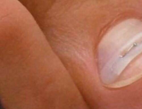 Wat doe je het best met een ingegroeide nagel?